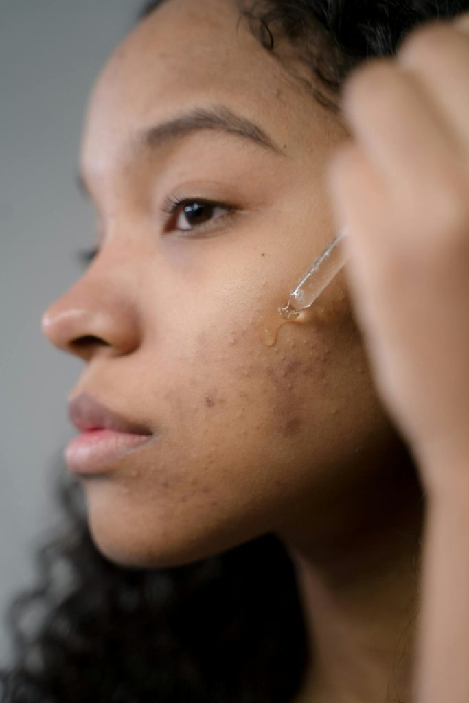 skin blemish